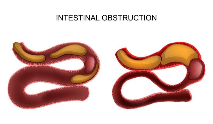 Διαφορές παραλυτικού και αποφρακτικού ειλεού