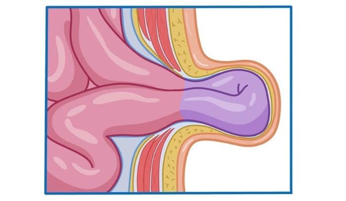 Περίσφιξη κήλης