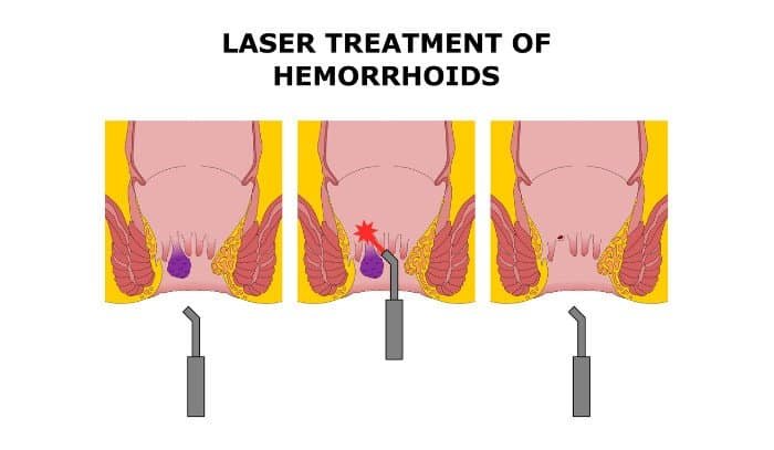 Αντιμετώπιση αιμορροΐδων με laser
